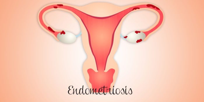 Endometriosis and Infertility - Wilcox Fertility of Pasadena, CA