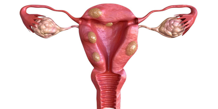 Wilcox Fertility - Understanding Fibroids
