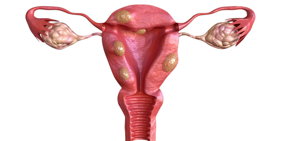 Wilcox Fertility - Understanding Fibroids